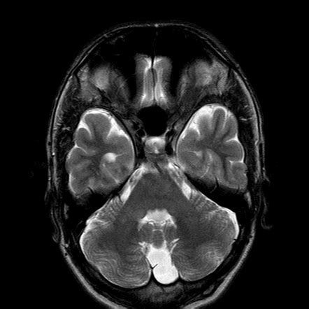 cisterna magna radiology|Iba pa.
